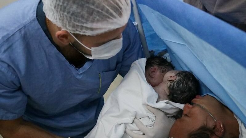 Parto raro de gêmeas siamesas é realizado com sucesso na rede pública de saúde do Amazonas